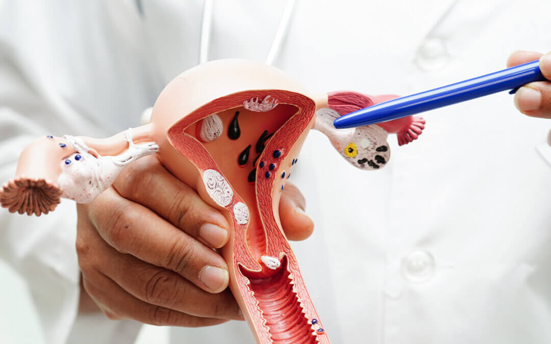 Cervical Cancer and Its Treatment Options