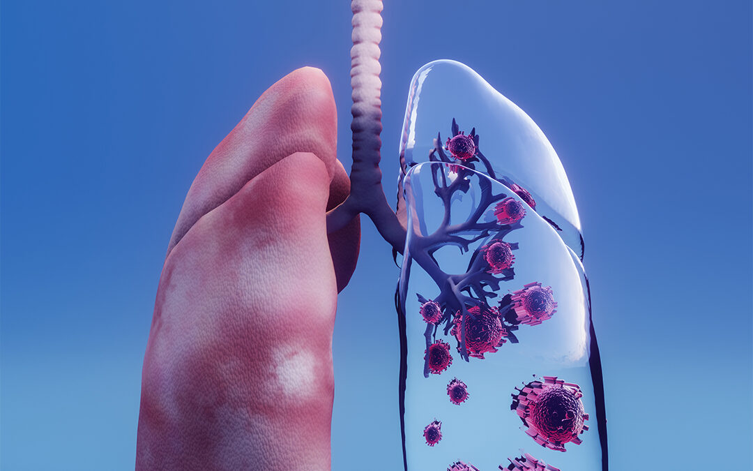Understanding Pneumonia: Causes, Symptoms, Treatment, and Lifestyle Changes